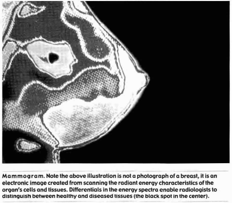 Mammogram